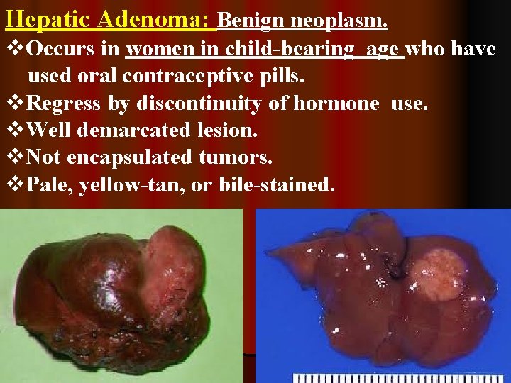 Hepatic Adenoma: Benign neoplasm. v. Occurs in women in child-bearing age who have used