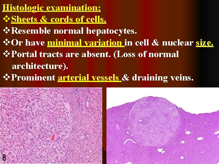 Histologic examination: v. Sheets & cords of cells. v. Resemble normal hepatocytes. v. Or