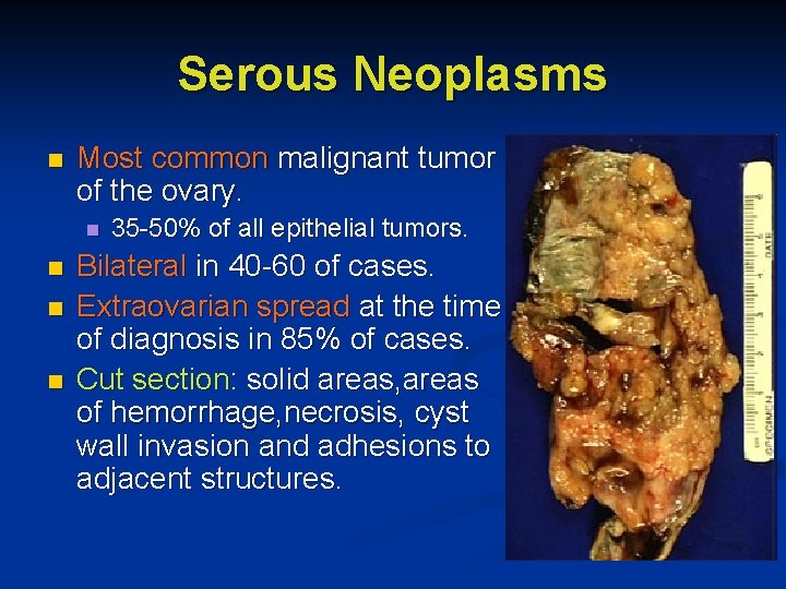 Serous Neoplasms n Most common malignant tumor of the ovary. n n 35 -50%