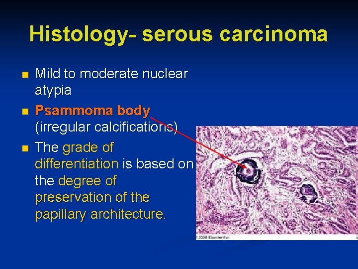 Histology- serous carcinoma n n n Mild to moderate nuclear atypia Psammoma body (irregular