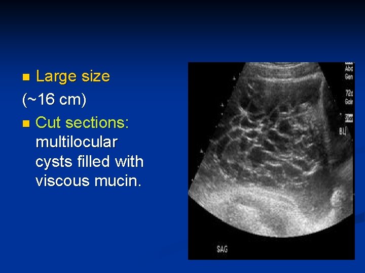 Large size (~16 cm) n Cut sections: multilocular cysts filled with viscous mucin. n