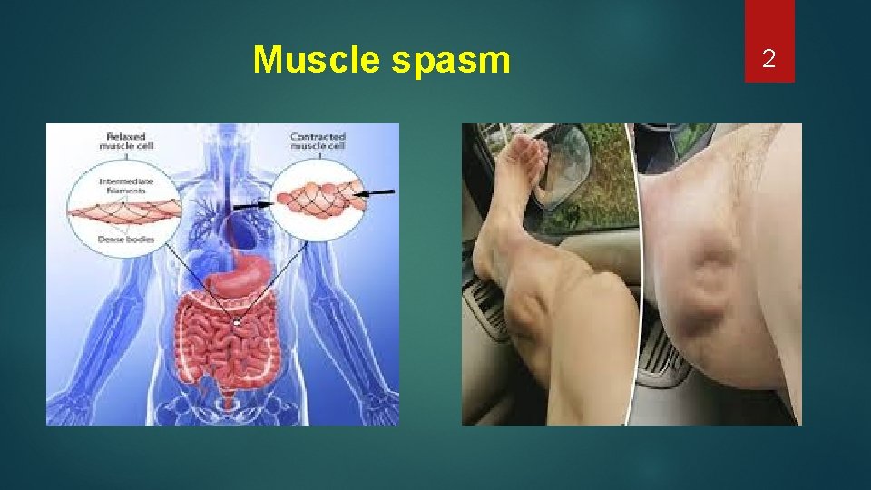 Muscle spasm 2 