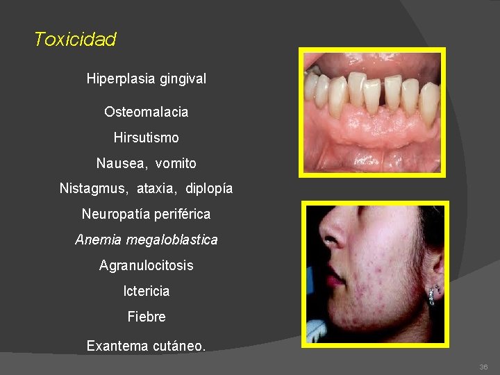 Toxicidad Hiperplasia gingival Osteomalacia Hirsutismo Nausea, vomito Nistagmus, ataxia, diplopía Neuropatía periférica Anemia megaloblastica