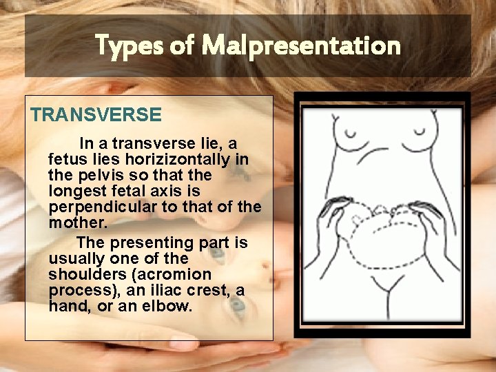 Types of Malpresentation TRANSVERSE In a transverse lie, a fetus lies horizizontally in the