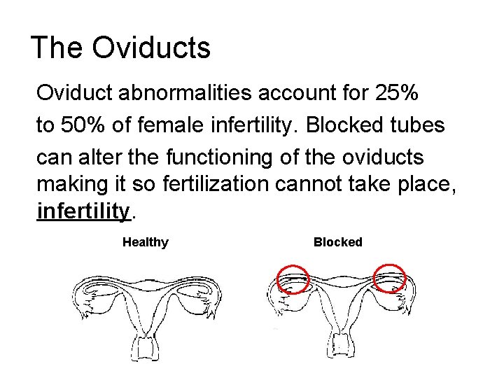 The Oviducts Oviduct abnormalities account for 25% to 50% of female infertility. Blocked tubes