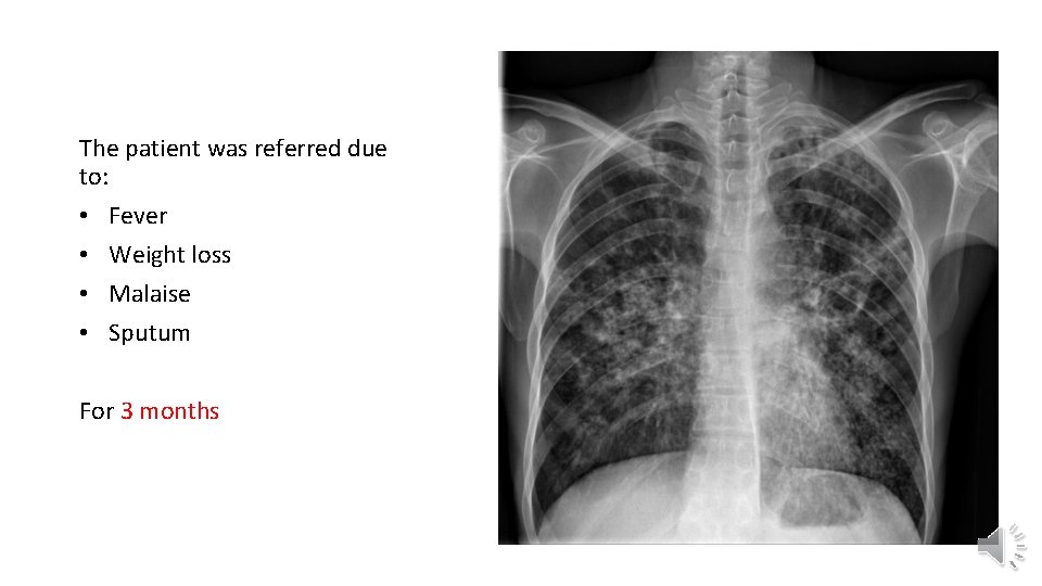 The patient was referred due to: • Fever • Weight loss • Malaise •