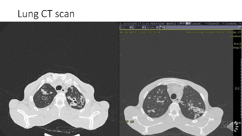 Lung CT scan 