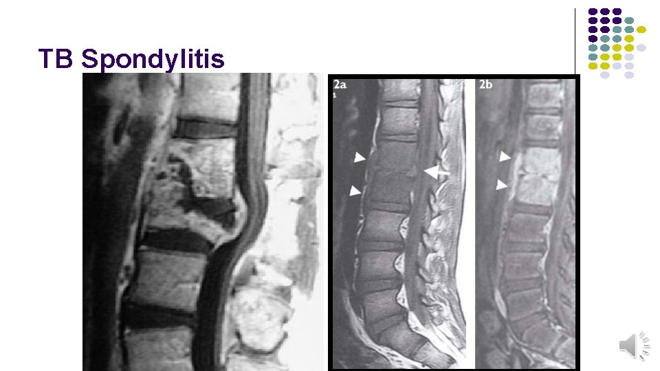 TB Spondylitis 