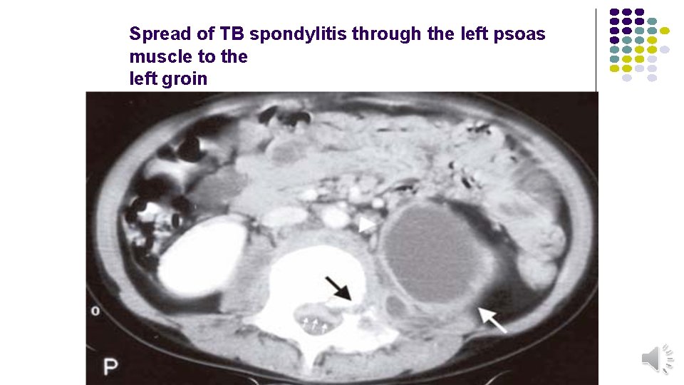 Spread of TB spondylitis through the left psoas muscle to the left groin 