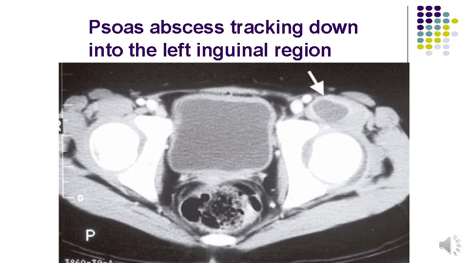 Psoas abscess tracking down into the left inguinal region 