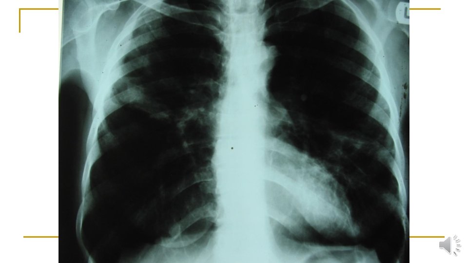 CXR 