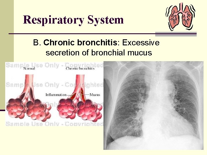 Respiratory System B. Chronic bronchitis: Excessive secretion of bronchial mucus 