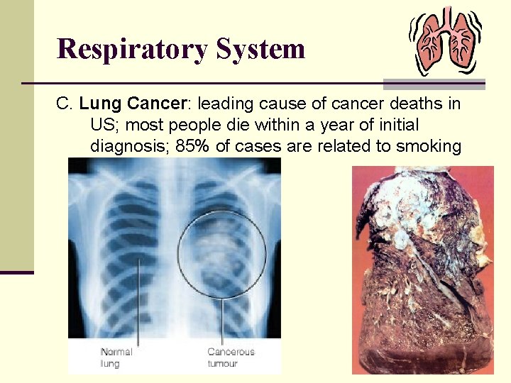 Respiratory System C. Lung Cancer: leading cause of cancer deaths in US; most people