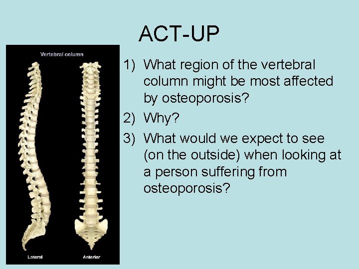 ACT-UP 1) What region of the vertebral column might be most affected by osteoporosis?