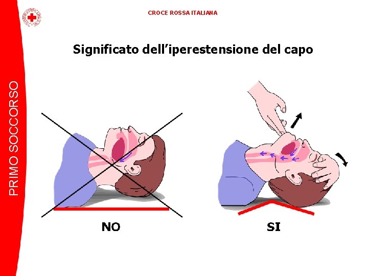 CROCE ROSSA ITALIANA PRIMO SOCCORSO Significato dell’iperestensione del capo 