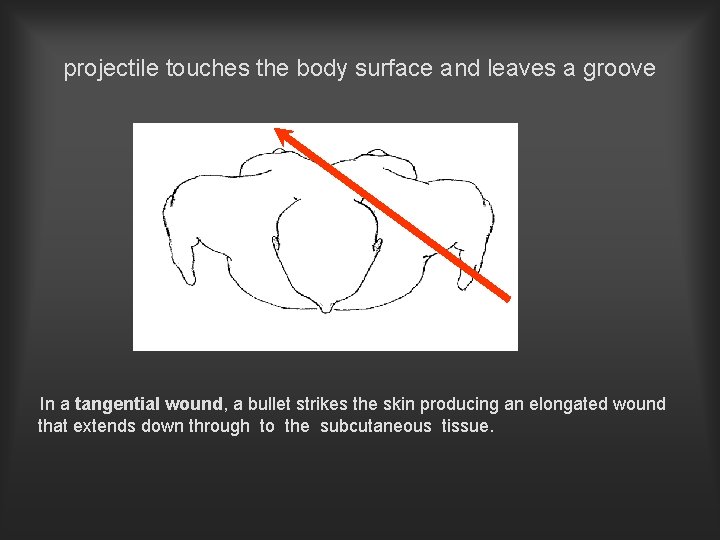 projectile touches the body surface and leaves a groove In a tangential wound, a