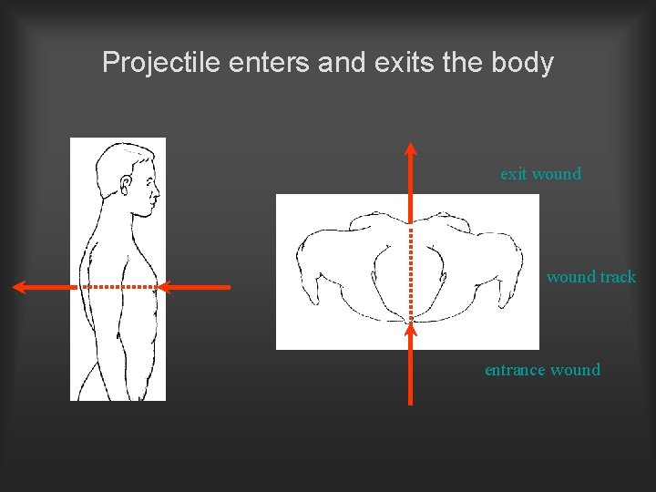 Projectile enters and exits the body exit wound track entrance wound 