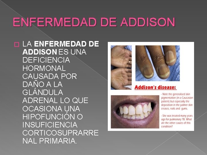 ENFERMEDAD DE ADDISON � LA ENFERMEDAD DE ADDISON ES UNA DEFICIENCIA HORMONAL CAUSADA POR