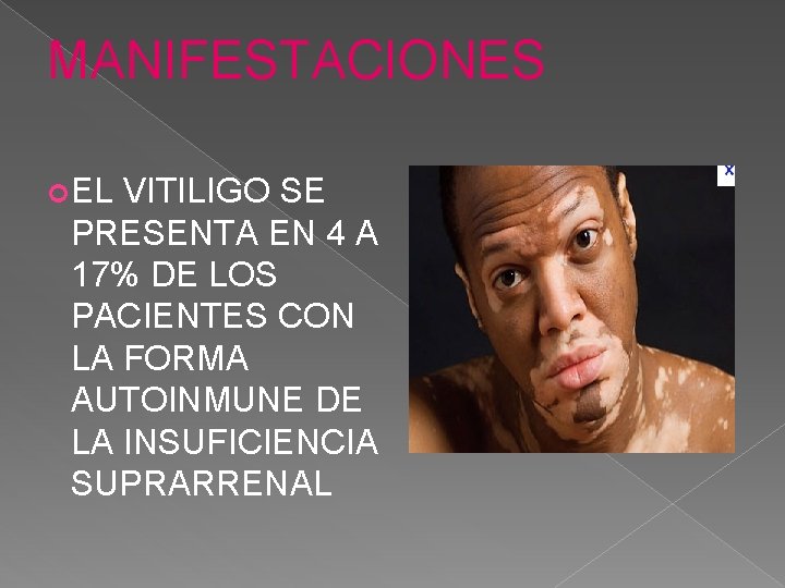 MANIFESTACIONES EL VITILIGO SE PRESENTA EN 4 A 17% DE LOS PACIENTES CON LA