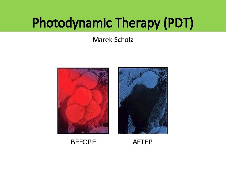 Photodynamic Therapy (PDT) Marek Scholz BEFORE AFTER 