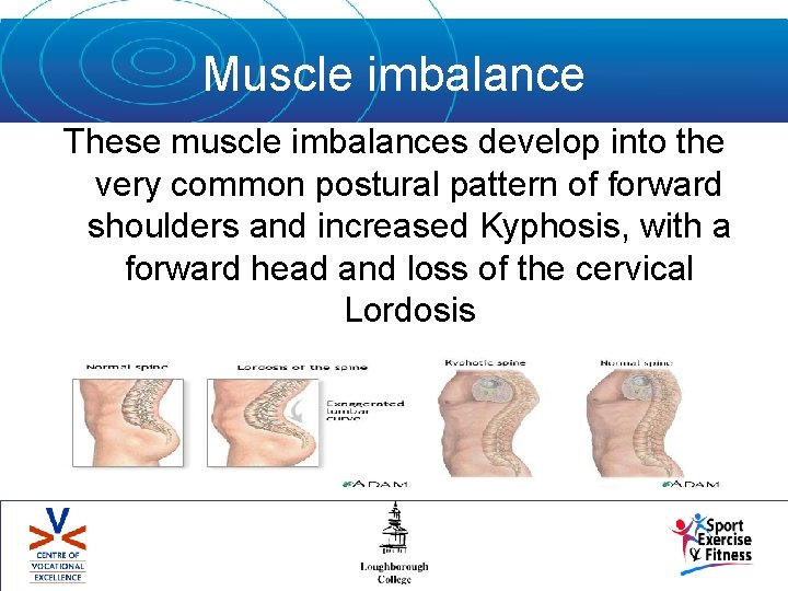 Muscle imbalance These muscle imbalances develop into the very common postural pattern of forward
