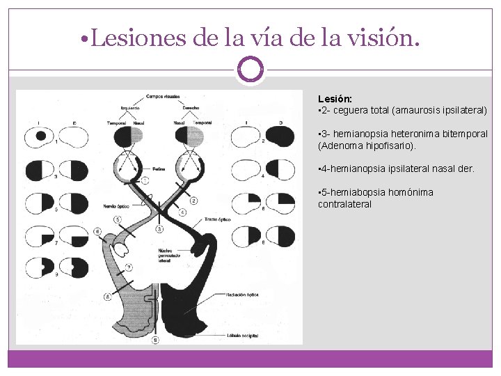  • Lesiones de la vía de la visión. Lesión: • 2 - ceguera