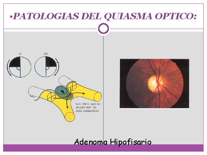  • PATOLOGIAS DEL QUIASMA OPTICO: Adenoma Hipofisario 