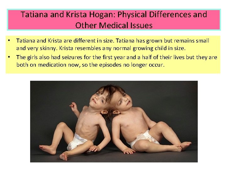 Tatiana and Krista Hogan: Physical Differences and Other Medical Issues • Tatiana and Krista