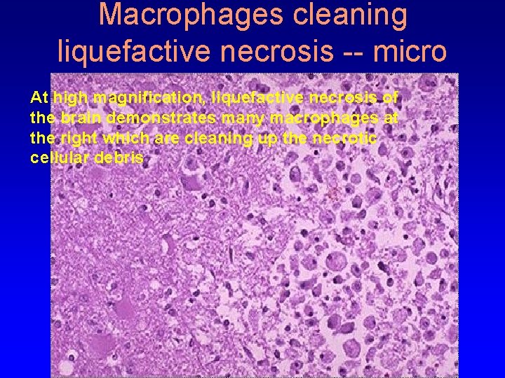 Macrophages cleaning liquefactive necrosis -- micro At high magnification, liquefactive necrosis of the brain