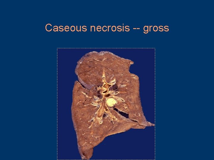 Caseous necrosis -- gross 