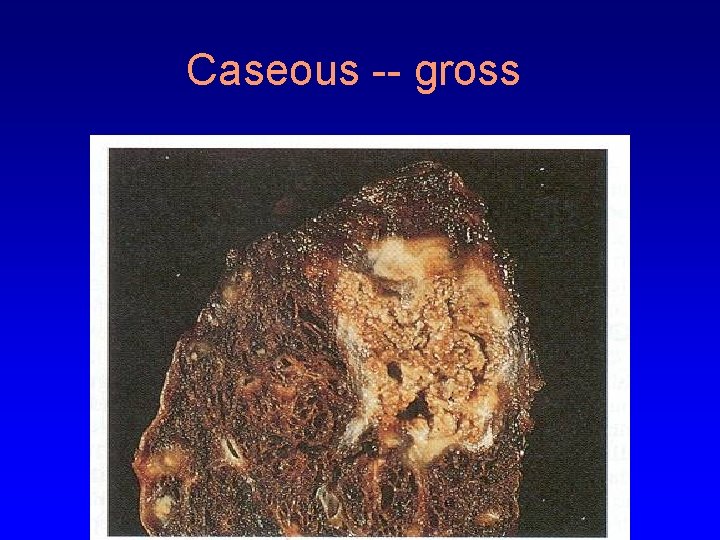 Caseous -- gross 