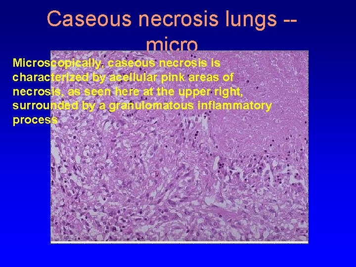 Caseous necrosis lungs -micro Microscopically, caseous necrosis is characterized by acellular pink areas of
