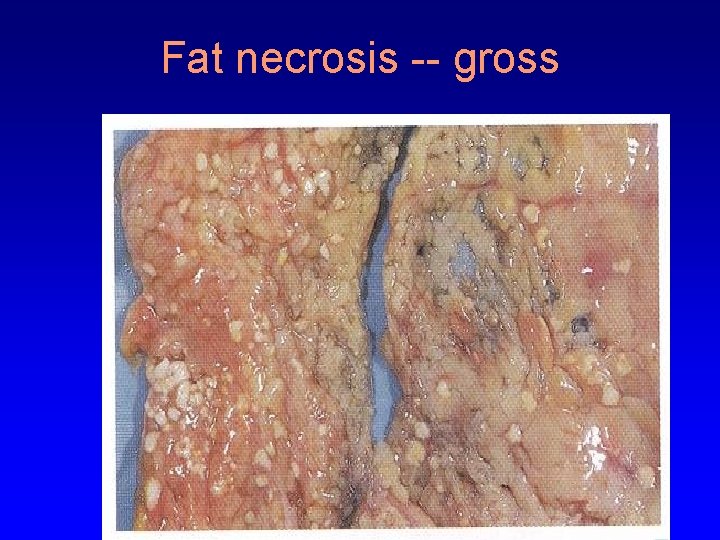 Fat necrosis -- gross 