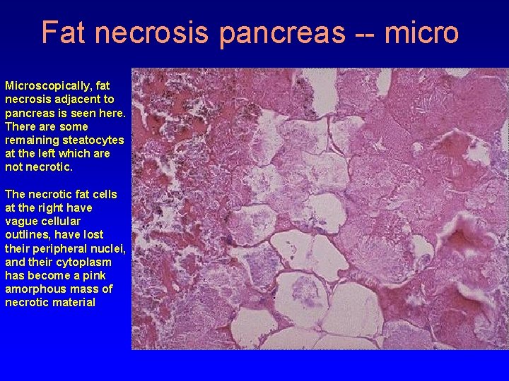 Fat necrosis pancreas -- micro Microscopically, fat necrosis adjacent to pancreas is seen here.