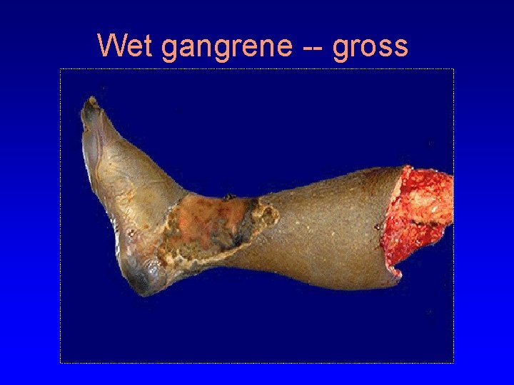 Wet gangrene -- gross 