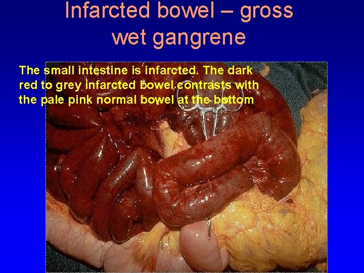 Infarcted bowel – gross wet gangrene The small intestine is infarcted. The dark red