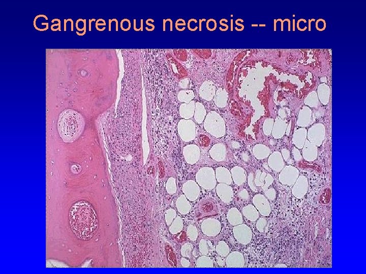 Gangrenous necrosis -- micro 