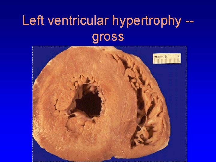 Left ventricular hypertrophy -gross 
