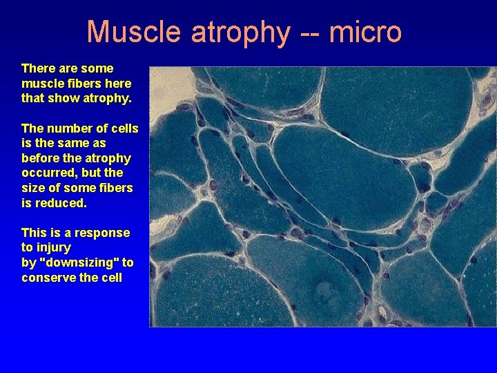 Muscle atrophy -- micro There are some muscle fibers here that show atrophy. The
