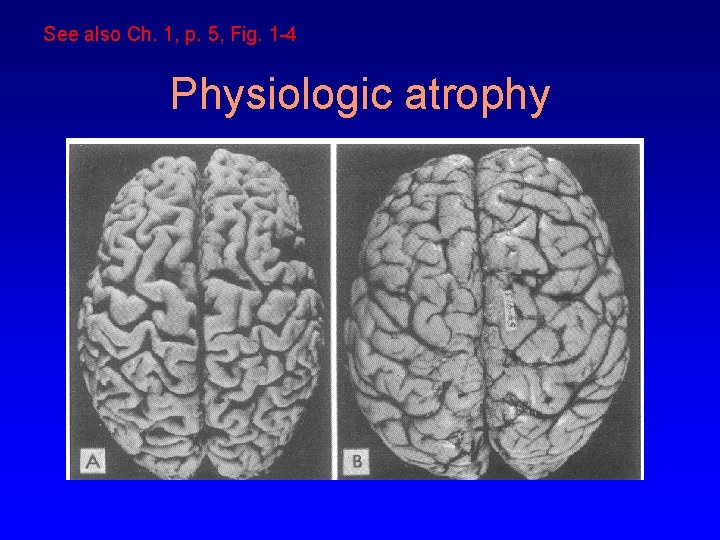See also Ch. 1, p. 5, Fig. 1 -4 Physiologic atrophy 