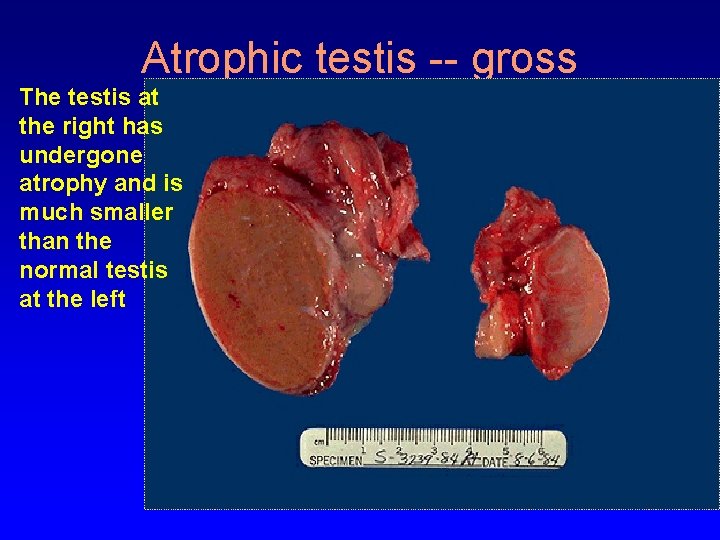 Atrophic testis -- gross The testis at the right has undergone atrophy and is