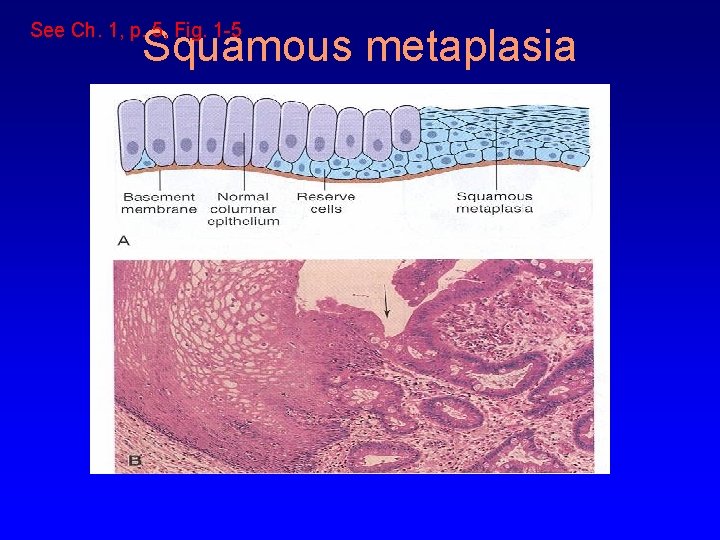 See Ch. 1, p. 5, Fig. 1 -5 Squamous metaplasia 