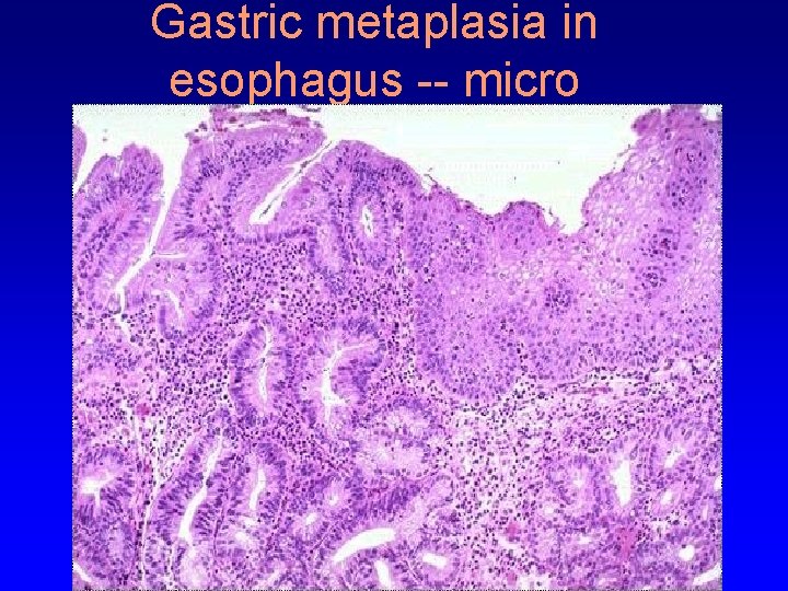 Gastric metaplasia in esophagus -- micro 