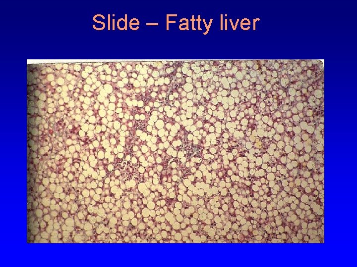 Slide – Fatty liver 