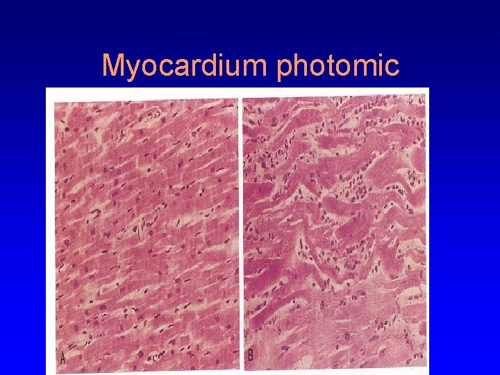 Myocardium photomic 