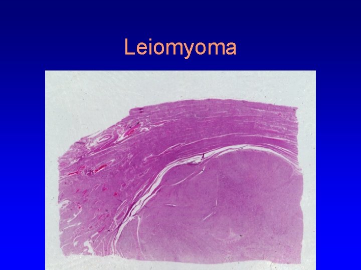 Leiomyoma 