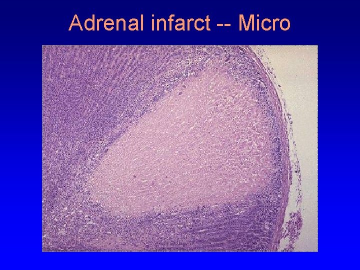 Adrenal infarct -- Micro 