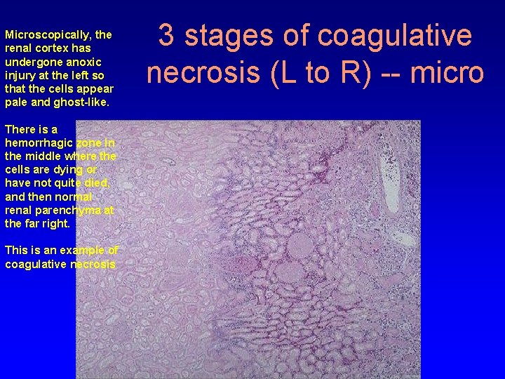 Microscopically, the renal cortex has undergone anoxic injury at the left so that the