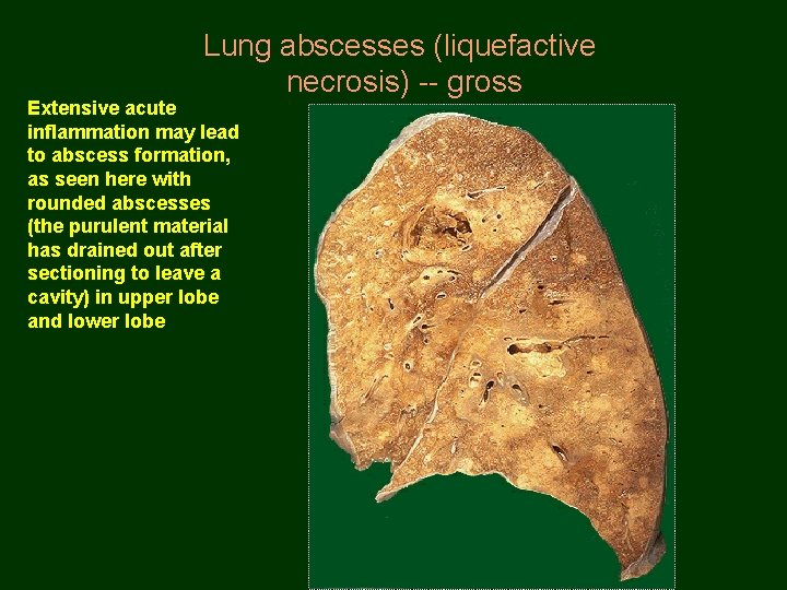 Lung abscesses (liquefactive necrosis) -- gross Extensive acute inflammation may lead to abscess formation,