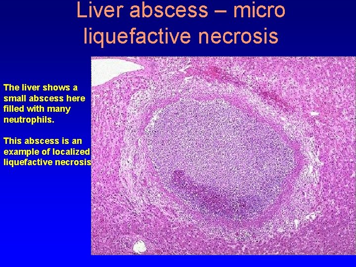 Liver abscess – micro liquefactive necrosis The liver shows a small abscess here filled